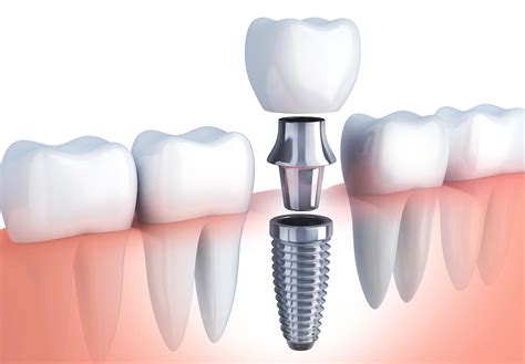 Por qué se usa titanio en los implantes dentales Uni2 Estética Dental