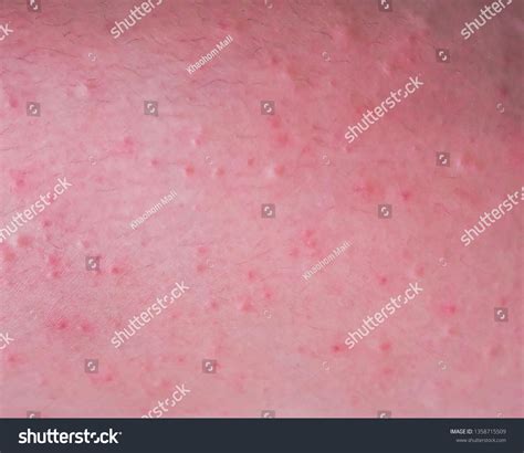 Skin Itching Rashred Spots On Skinred Stock Photo 1358715509 Shutterstock