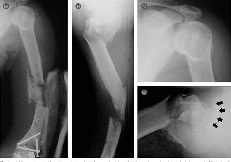 Figure 1 From Fracture Dislocation Of The Proximal Humerus With