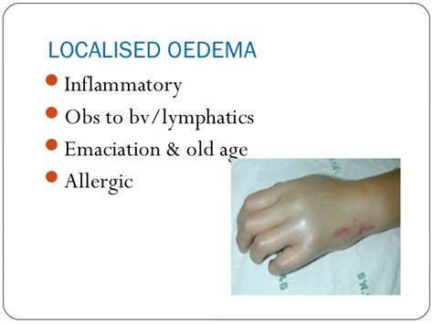 Causes Of Edema
