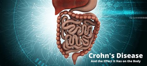 Crohn’s Disease And The Effect It Has On The Body Spoke Research
