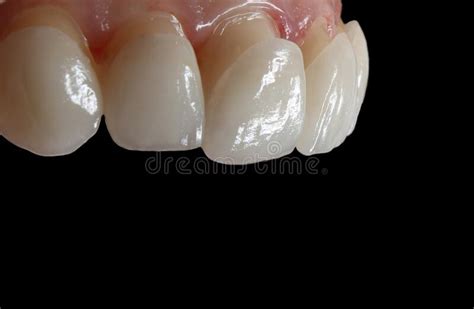 Dental Ceramic Veneers On The Black Background Stock Photo Image Of
