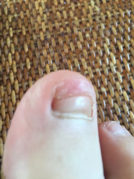 Help Toenail Fell Off Now What With Pic Sorry Mumsnet