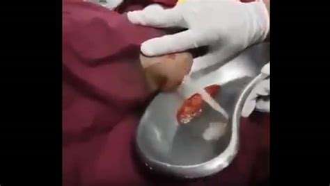 Biggest Cyst Explosion Ever Seen New Pimple Popping