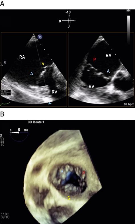 3 Dimensional Echocardiography In Imaging The Tricuspid Valve Jacc