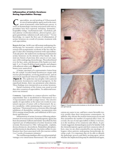 Inflammation Of Actinic Keratoses During Capecitabine Therapy