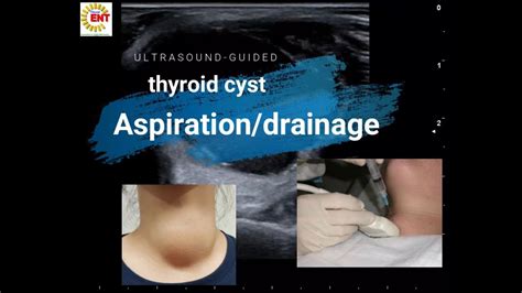 Thyroid Cystic Nodule Ultrasound Guided Drainageaspiration Youtube
