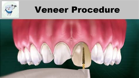 Dental Veneers Procedure Step By Step Youtube