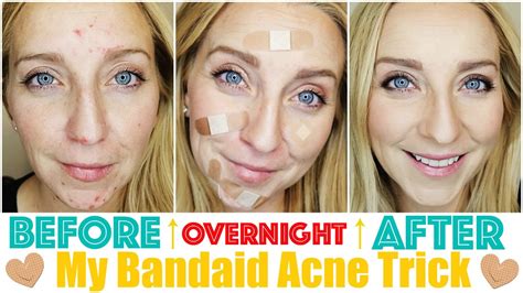 How To Get Rid Of Acne Fast And Overnight With My Bandaid Trick Youtube
