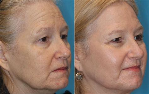 Halo Laser For Under Eye Wrinkles Cosmetic Surgery Tips