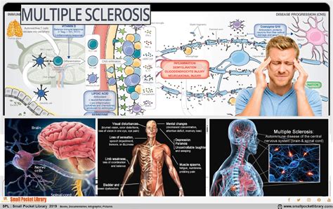 Multiple Sclerosis Causes And Treatment