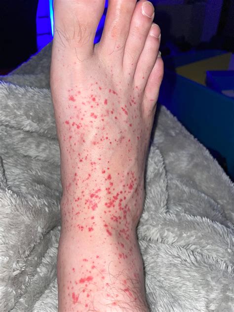 Recycler Accusation Piquer Red Spots On Feet Sortir Amérique Mortel