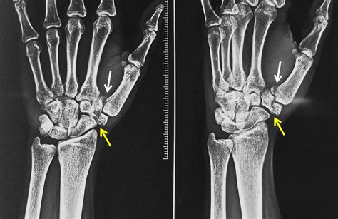 Cureus Combined Bennett Fracture Dislocation And Trapezium Fracture