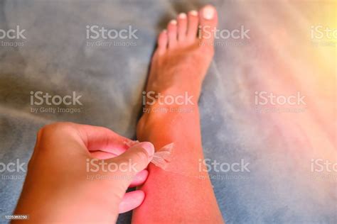 Burnt Red Skin On The Legs After Sunburn Real Photo Stock Photo