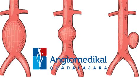 Aneurisma De Aorta Abdominal Angiología Cirugía Vascular Y Endovascular