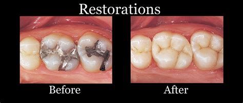 Restorations Dr Krinita Motwani Dental Clinic