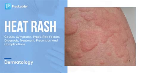 Heat Rash Causes Symptoms Types Risk Factors Diagnosis Treatment
