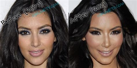 Shop @skims neon fits everybody tuesday, 05.25 at 9am pt. Kim Kardashian Before and After Surgery ~ Styles & Trends