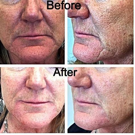 Botox Facelift Before And After Pictures 2 Botox Face Botox Facelift