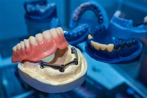 Dentures Vs Implants Houston Tx Cosmetic Dentistry