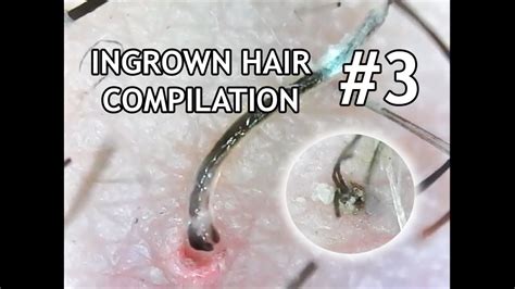 Ingrown Hair Compilation 3 And And Update On My Health Youtube