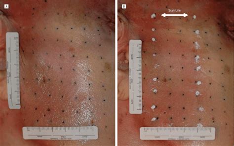 Digital Photographs Of The Intense Ultrasound Exposure Area Right