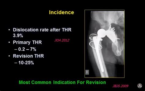 Dislocation After Total Hip Replacement —