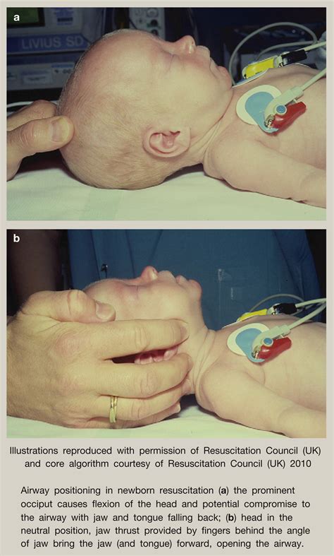 Resuscitation Of The Newborn Anaesthesia And Intensive Care Medicine