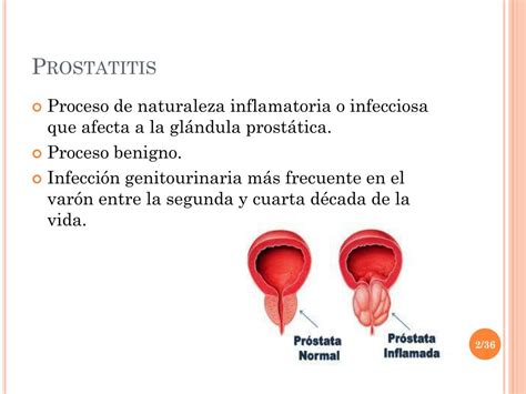 Ppt Prostatitis Powerpoint Presentation Free Download Id