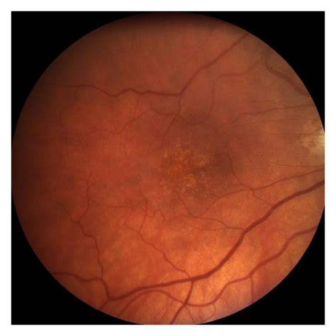 A Fundus Photo Of The Right Eye With Early Non Neovascular Dry Amd