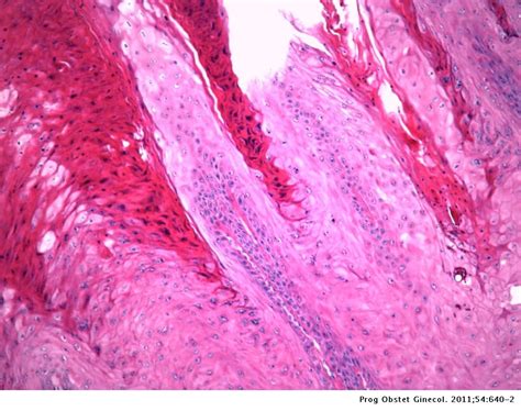Carcinoma Verrugoso De Vagina Presentación De Un Caso Progresos De