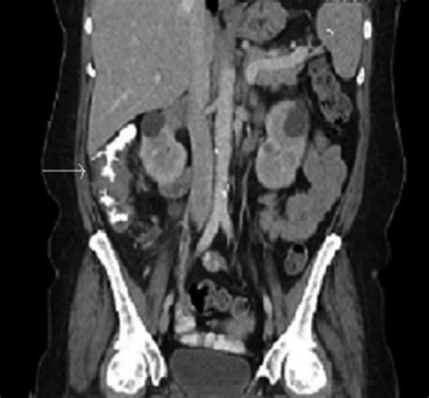 Ct Scan Of Abdomen With Contrast With Apple Core Lesion In Ascending