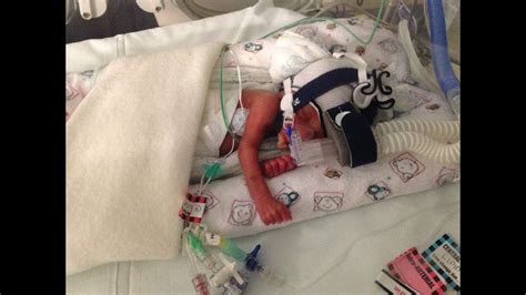Born Preemie At 24 Weeks Virginias Testimony Youtube