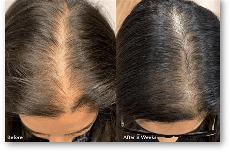 Top Image Hair Growth For Women Thptnganamst Edu Vn