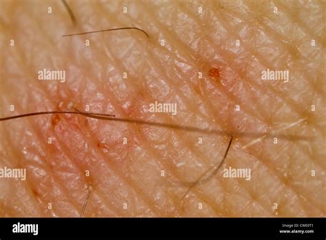 Scabies Infected Skin Close Up Stock Photo Royalty Free Image