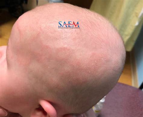 Saem Clinical Images Series A Rare Pediatric Scalp Rash