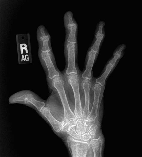 Hand Arthritis On X Rays Raleigh Hand To Shoulder Center