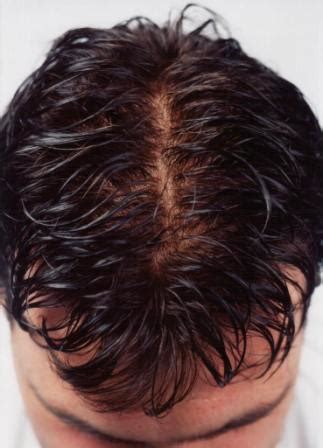 In a fut hair transplant the follicles are transplanted using a method known as follicular unit transplantation (where the the area where the strip of scalp was removed is closed with stitches. Treatments for Men at New England Associates