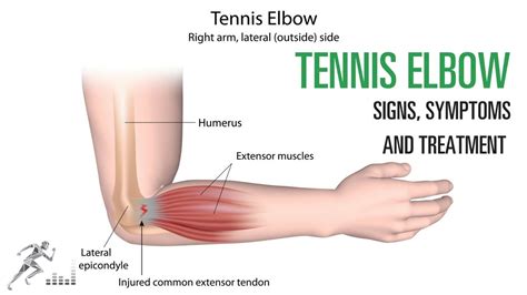 I stretch them out before and find i sometimes have to put my hands into a fist so my wrists are straight, which relieves some of the strain. Tennis elbow: Signs and symptoms and treatment of the ...
