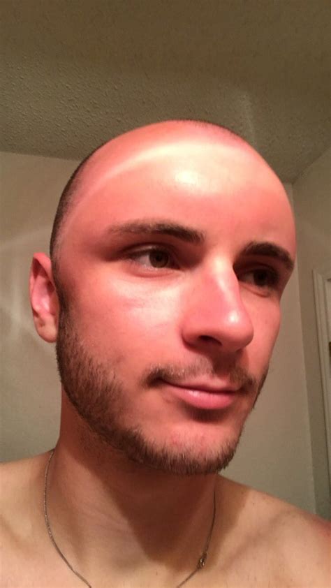Mans Head Dent Shows One Harmful Effect Of Sun Exposure