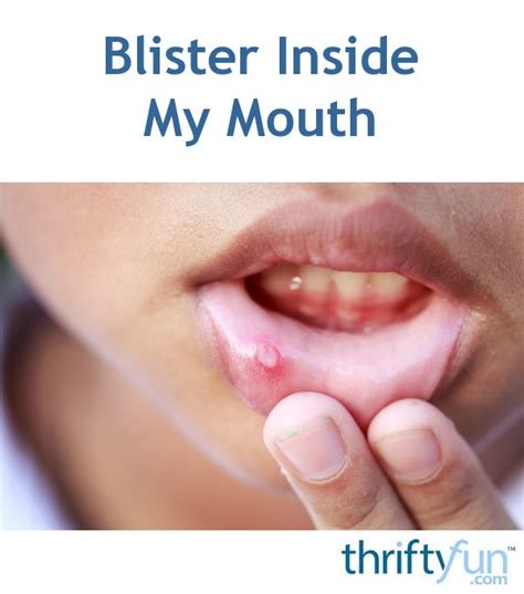 Treating A Blister Inside My Mouth Thriftyfun