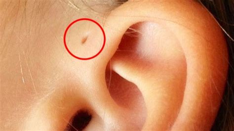 If You Have A Tiny Hole Above Your Ear Heres What It Means Viral
