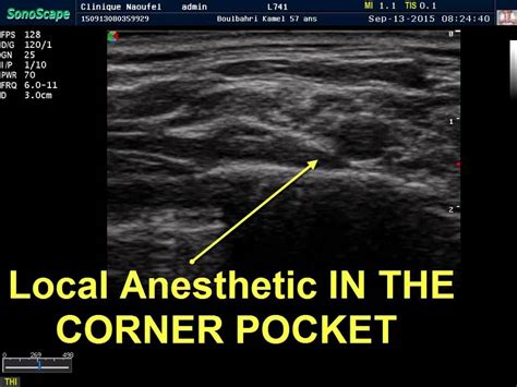 Ultrasound Guided Supraclavicular Block Youtube