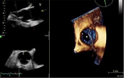 Cureus Infective Aortic Valve Endocarditis In A Patient With Mixed