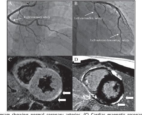 Figure 2 From Acute Myocarditis Mimicking St Elevation Myocardial