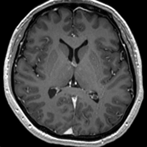 Choroid Plexus Xanthogranuloma Neuro Mr Case Studies Ctisus Ct Scanning