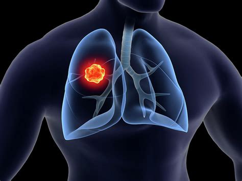 Medical Illustration Of Lung Cancer Photograph By Stocktrek Images