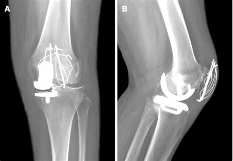 Internal Fixation And Unicompartmental Knee Arthroplasty For An Elderly