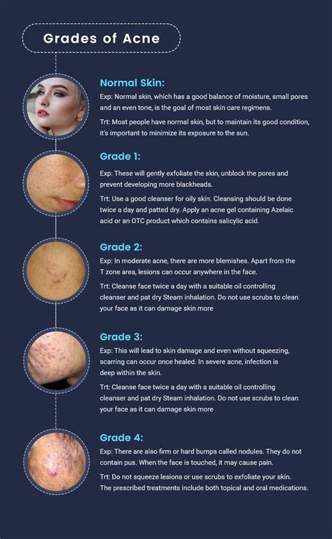 Grades Of Acne Acne Skin Dryskin Acneonface Grade1 Cureskinissues