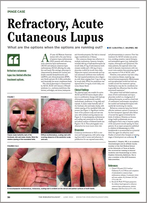 Dermatologist Rheumatologist Discuss Refractory Cutaneous Lupus Case
